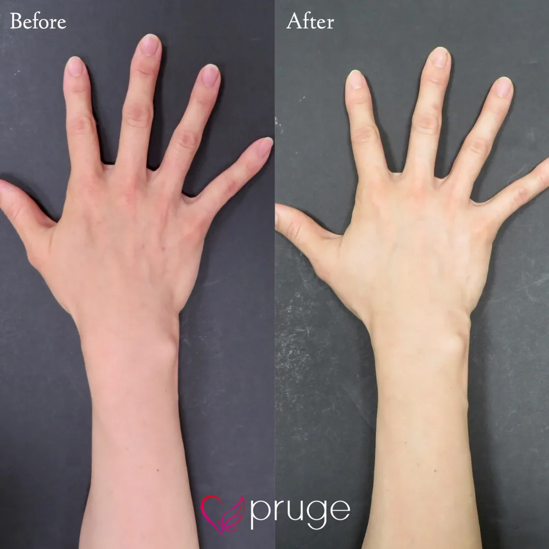 PRP注射（手の甲）