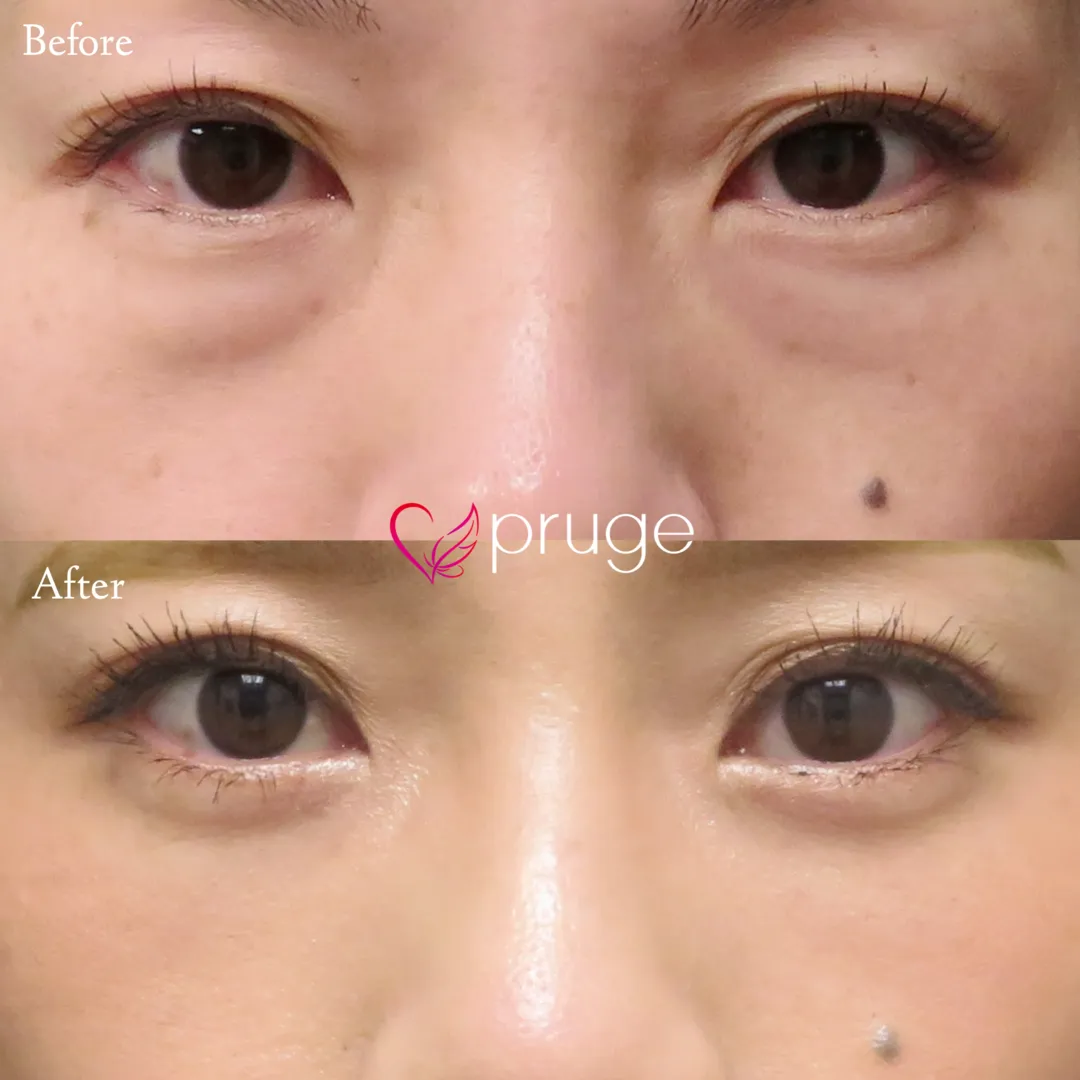 PRP-MI脱脂術（目の下）