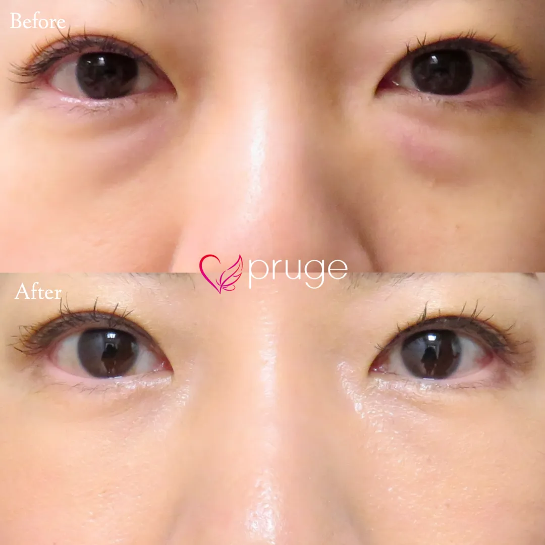 PRP-MI脱脂術（目の下）