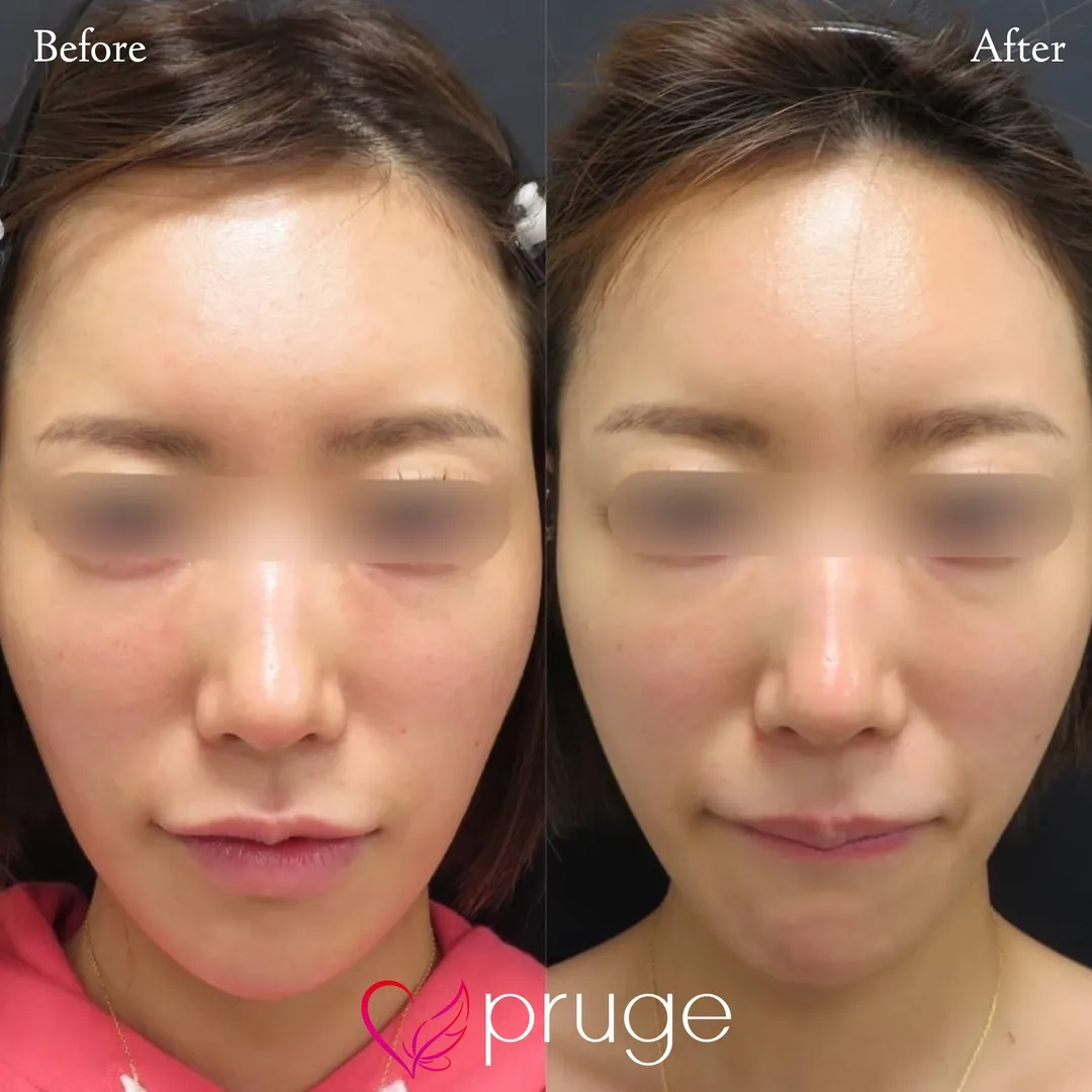 額・こめかみの凹み