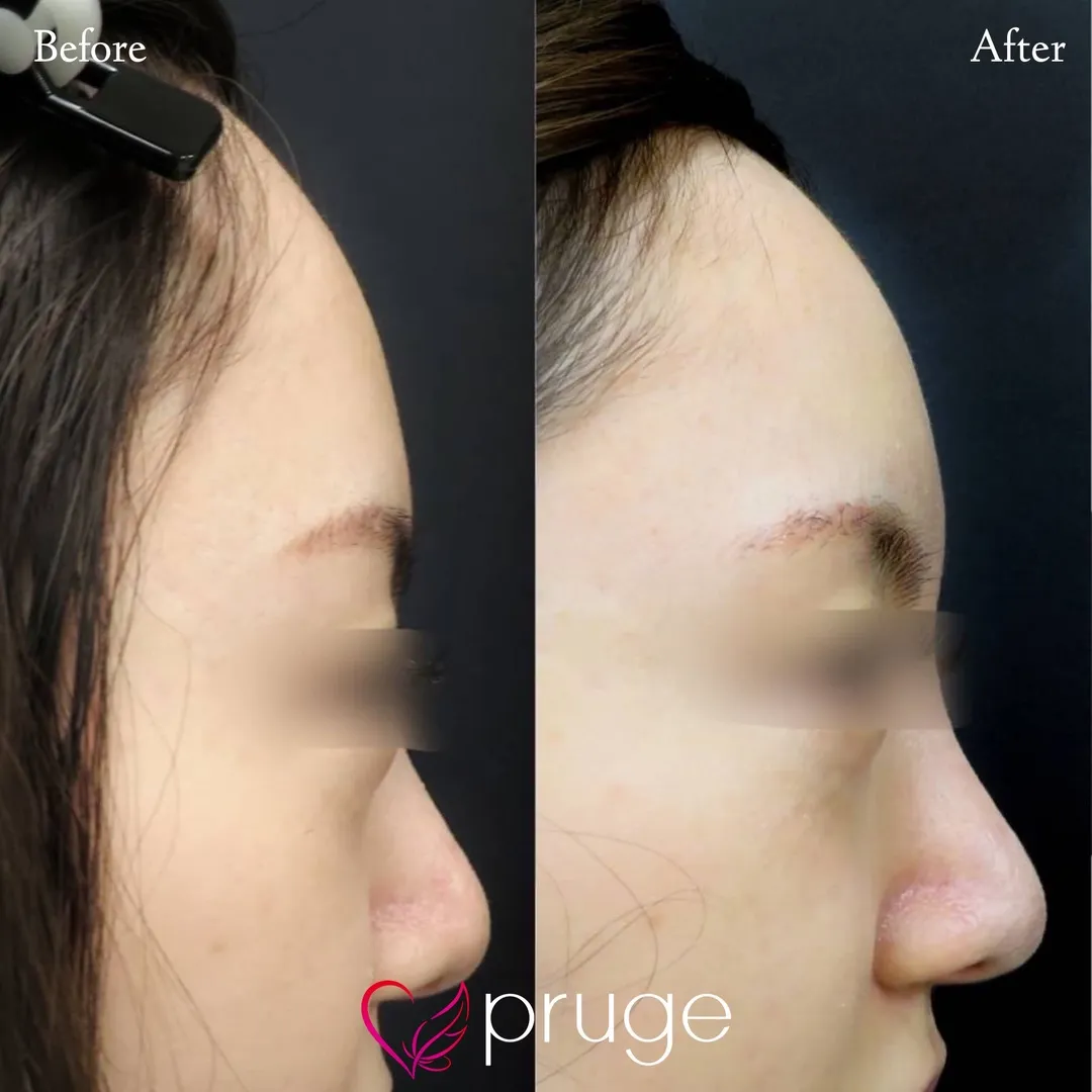 額・こめかみの凹み