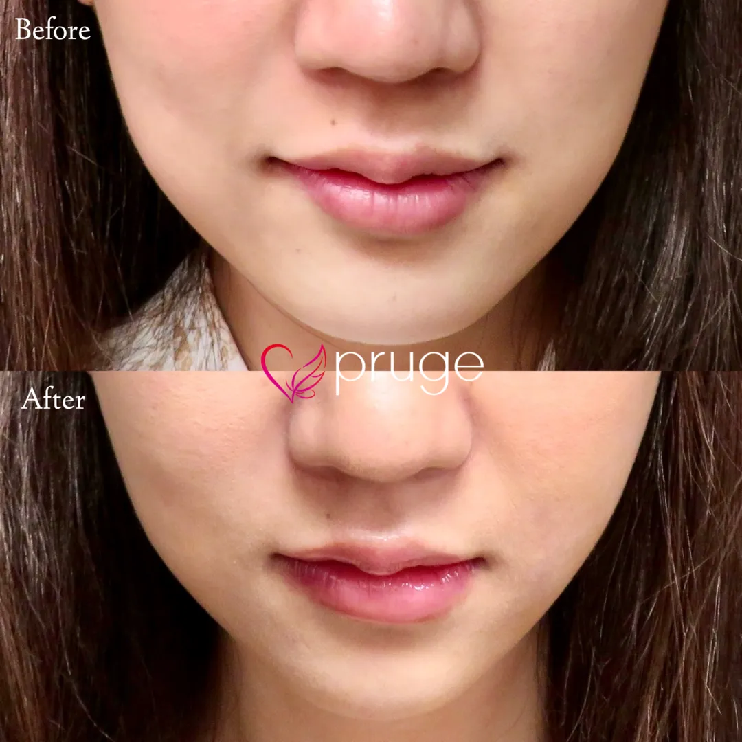 pスリム注射（フェイスライン）