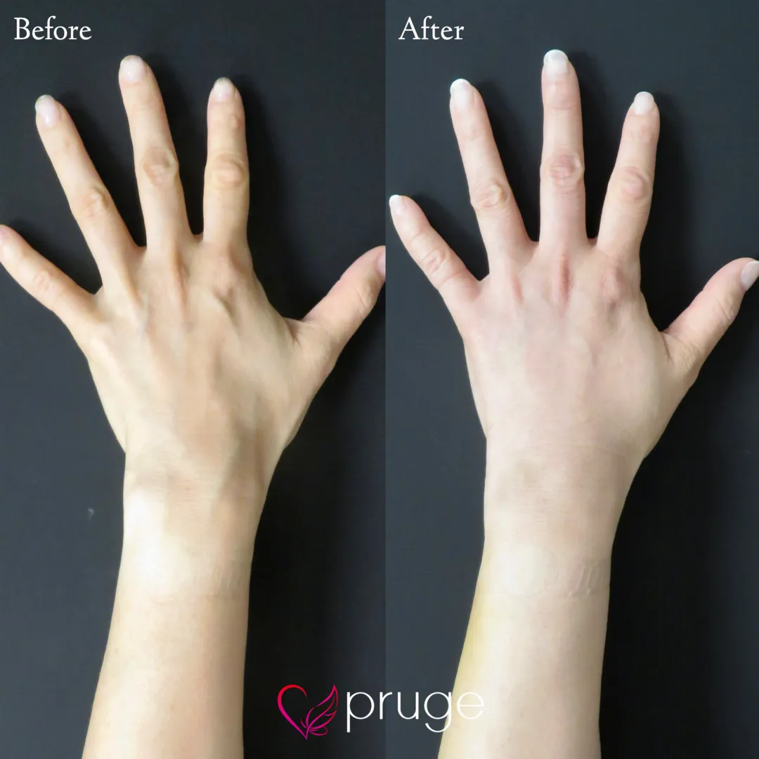 PRP注射（手の甲）