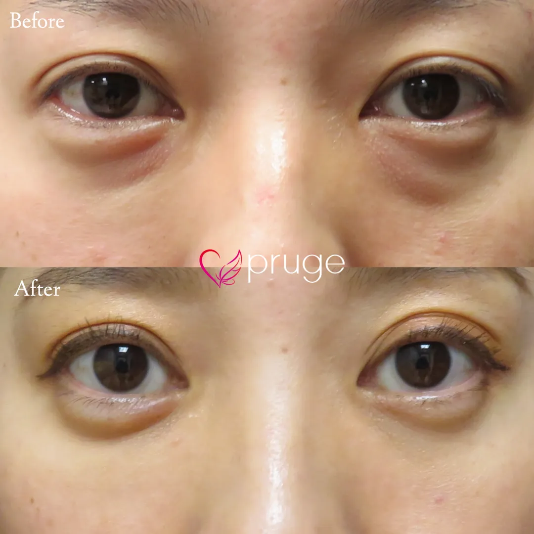 PRP-MI脱脂術（目の下）