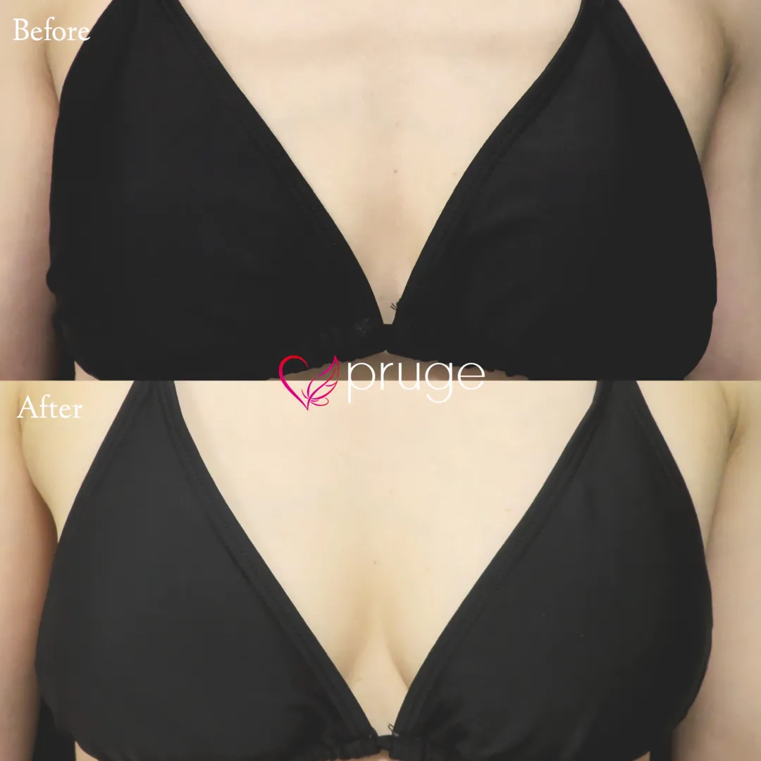 PRP注射（お胸）