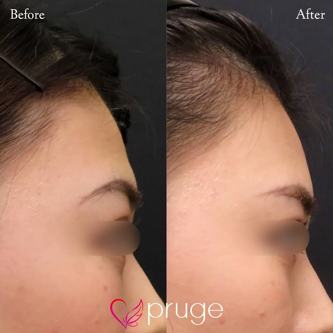 額の傾斜・凹み