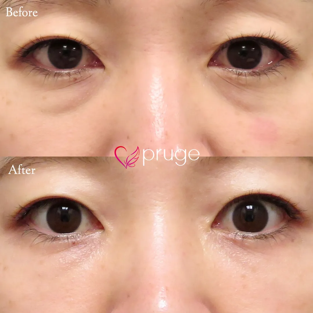 PRP-MI脱脂術（目の下）