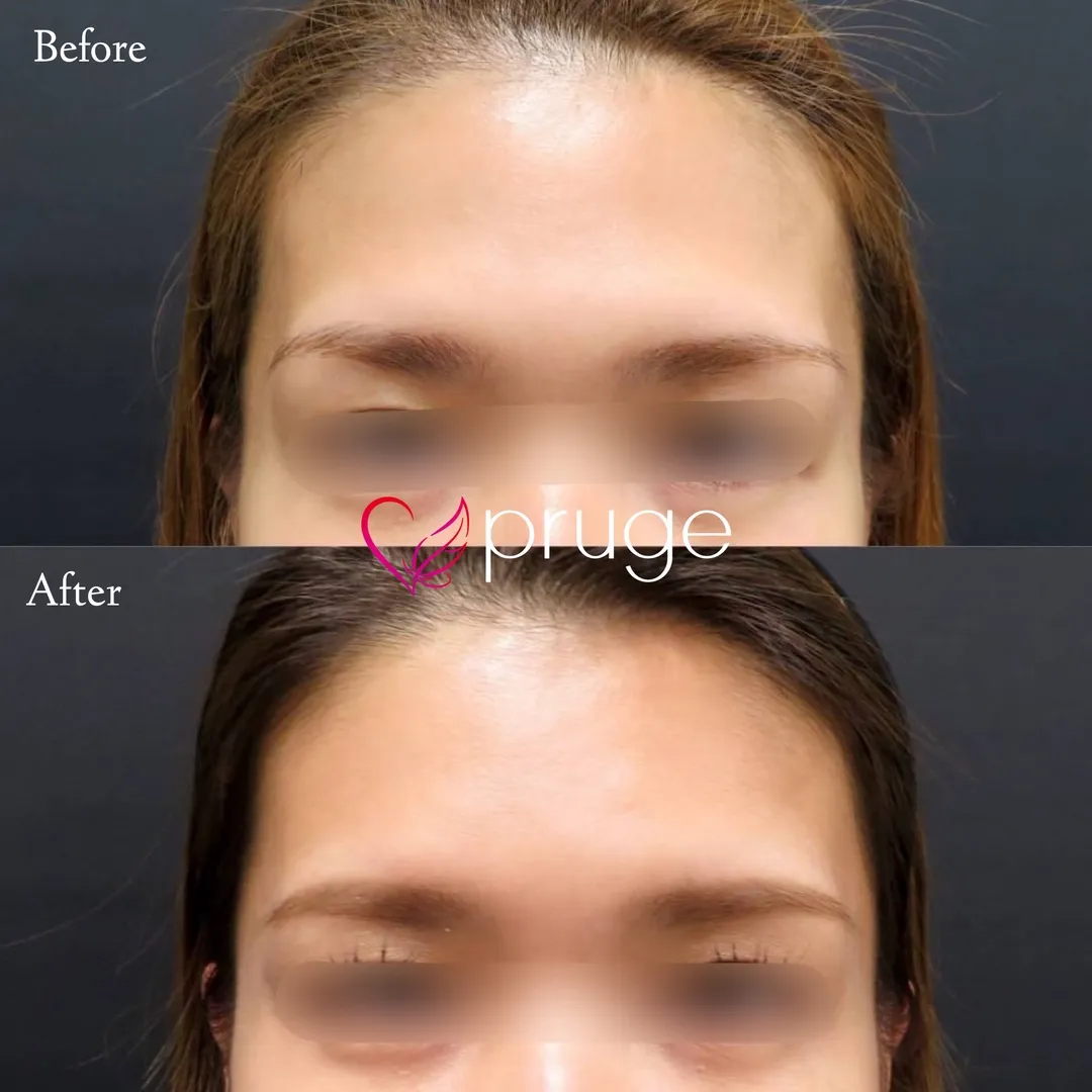 額・こめかみの凹み