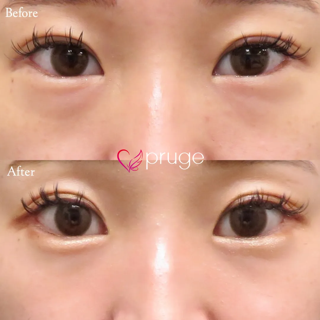 PRP-MI脱脂術（目の下）