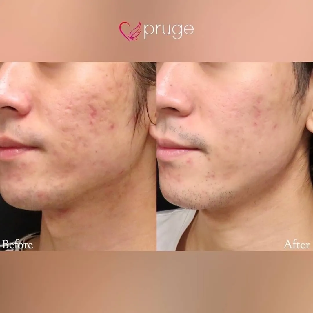 ヴァンパイアフェイシャル（全顔）