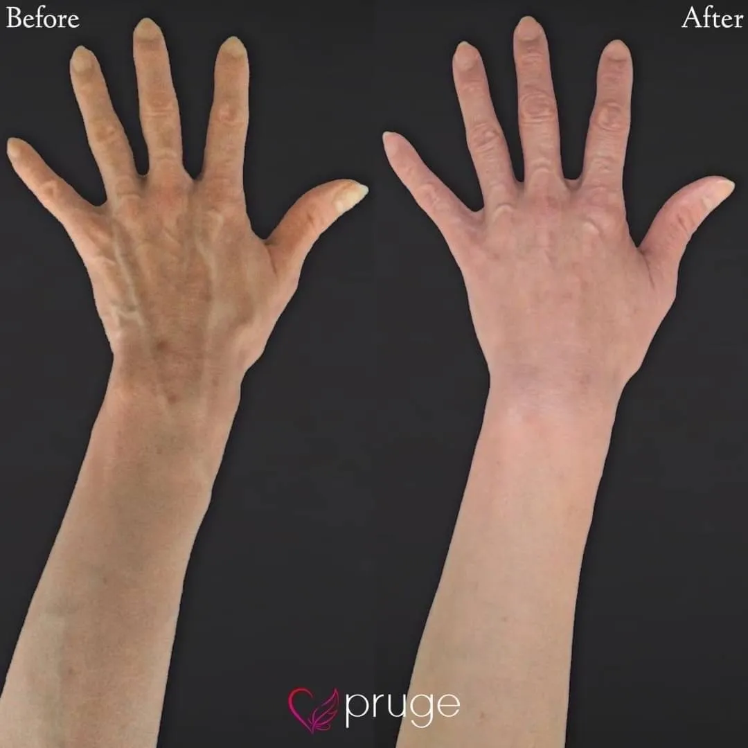 PRP注射（手の甲）