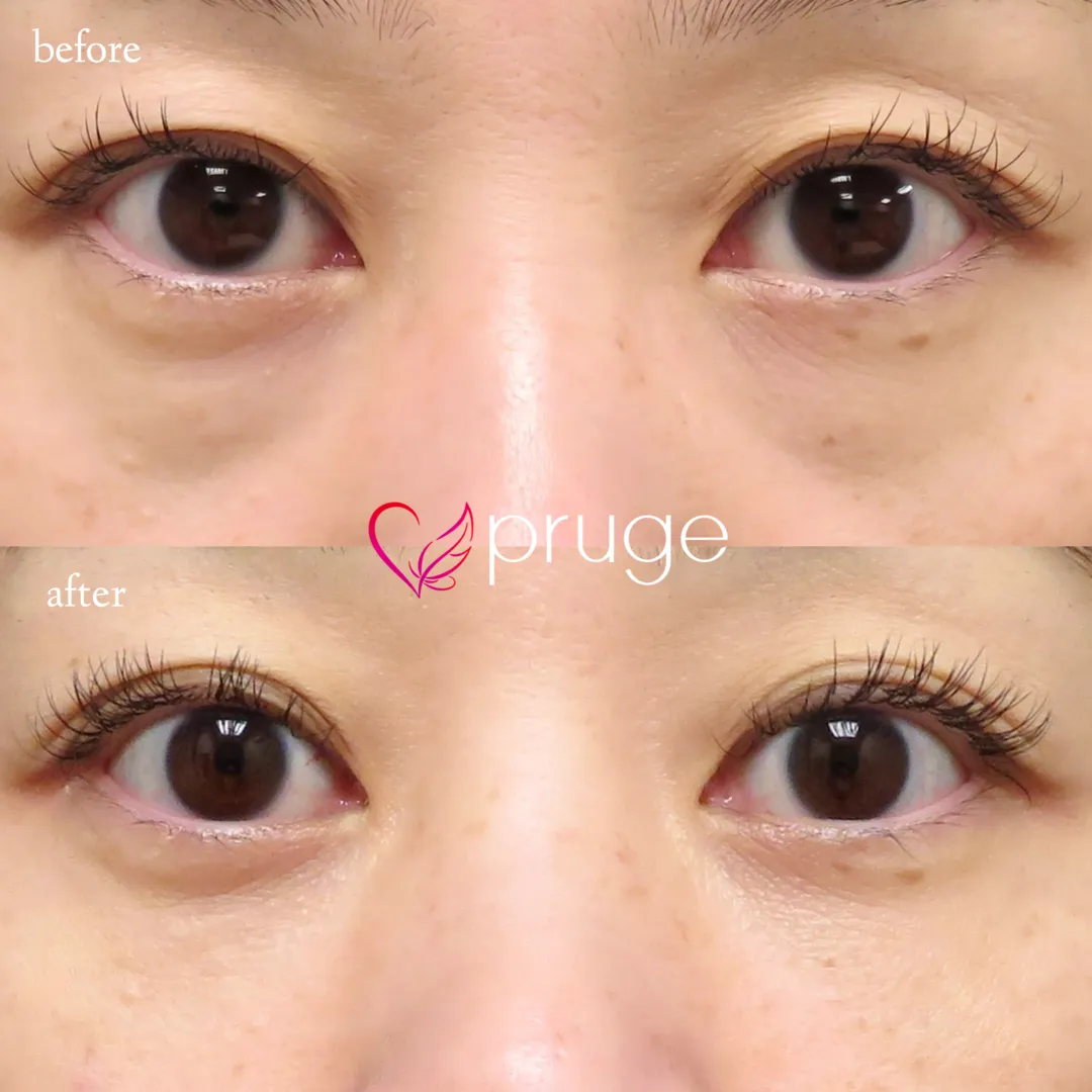 PRP-MI脱脂術（目の下）