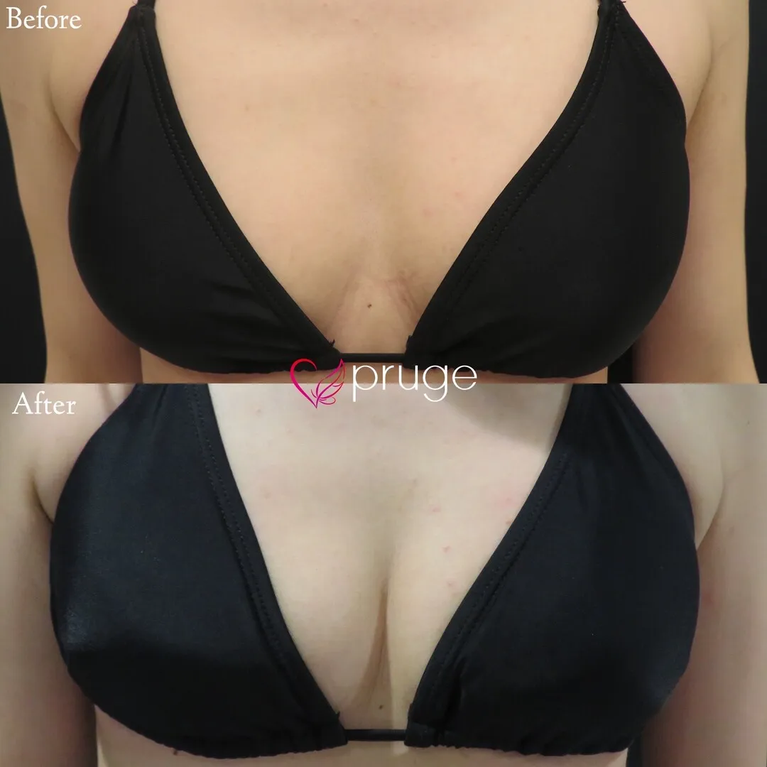 PRP注射（お胸）