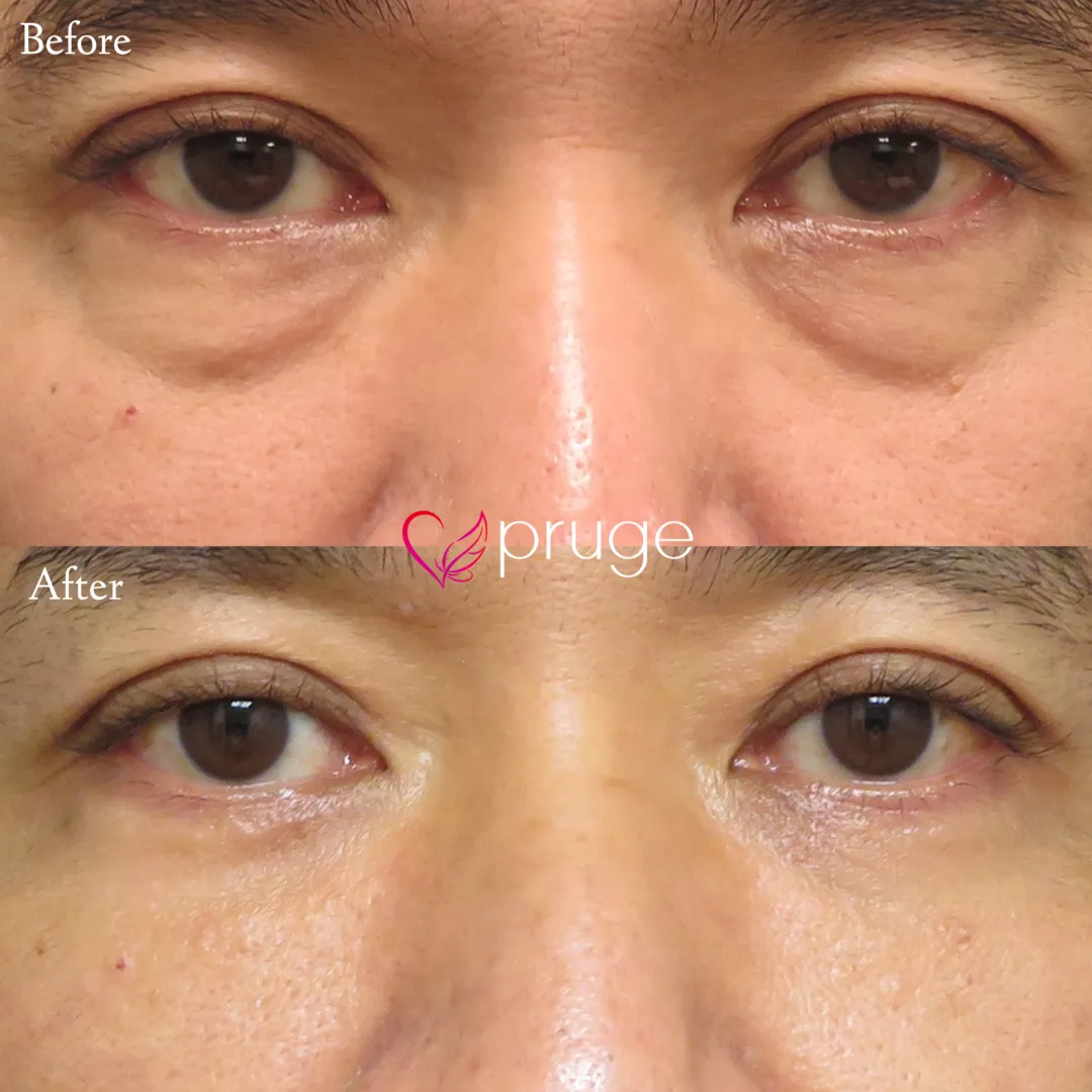 PRP-MI脱脂術（目の下）