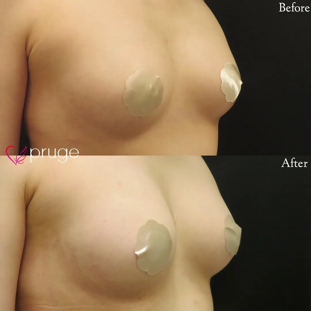 PRP注射によるバストアップ