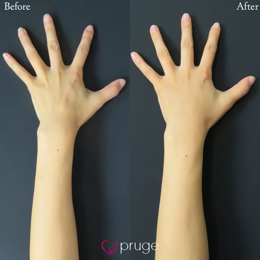 PRP注射（手の甲）