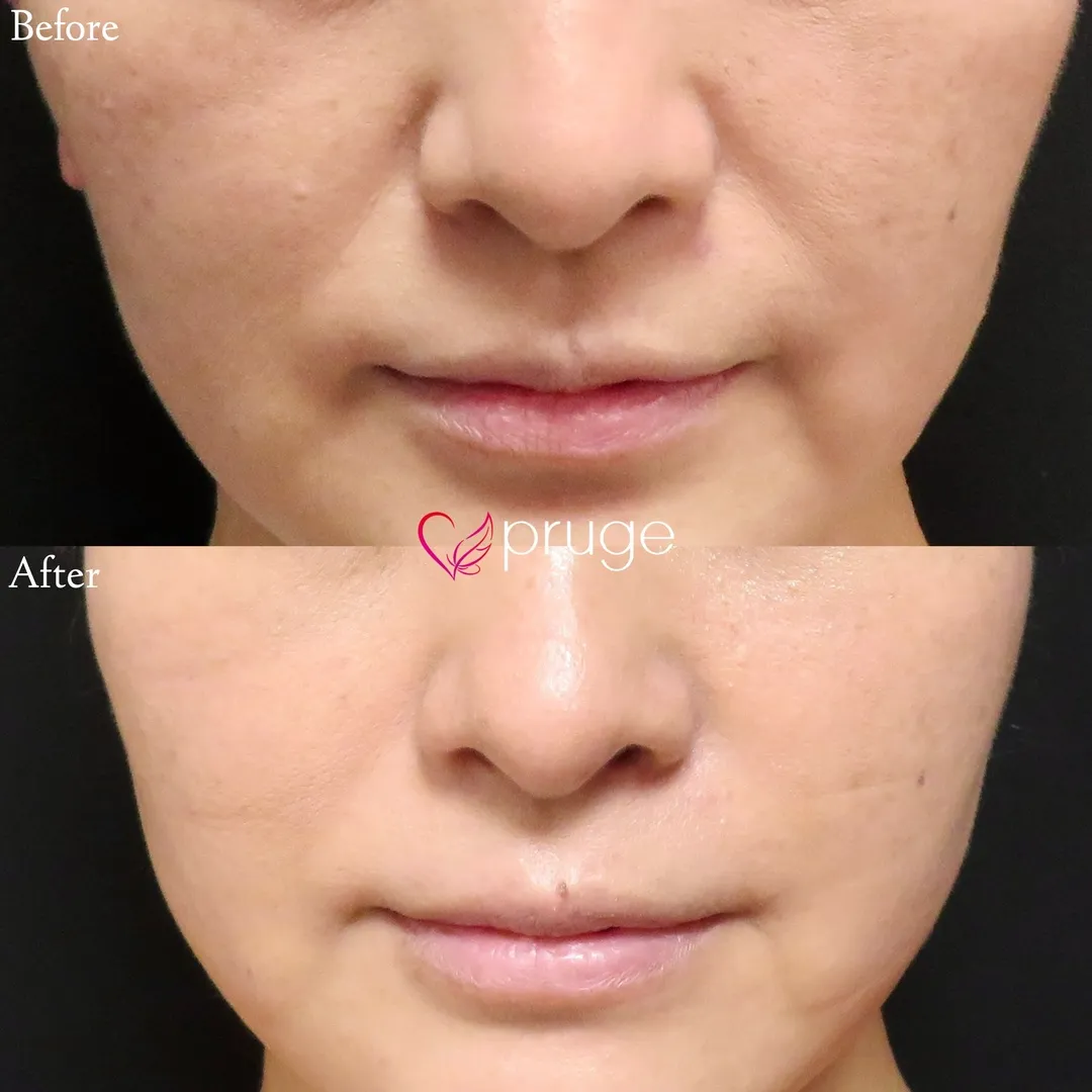 PRP注射（ほうれい線）