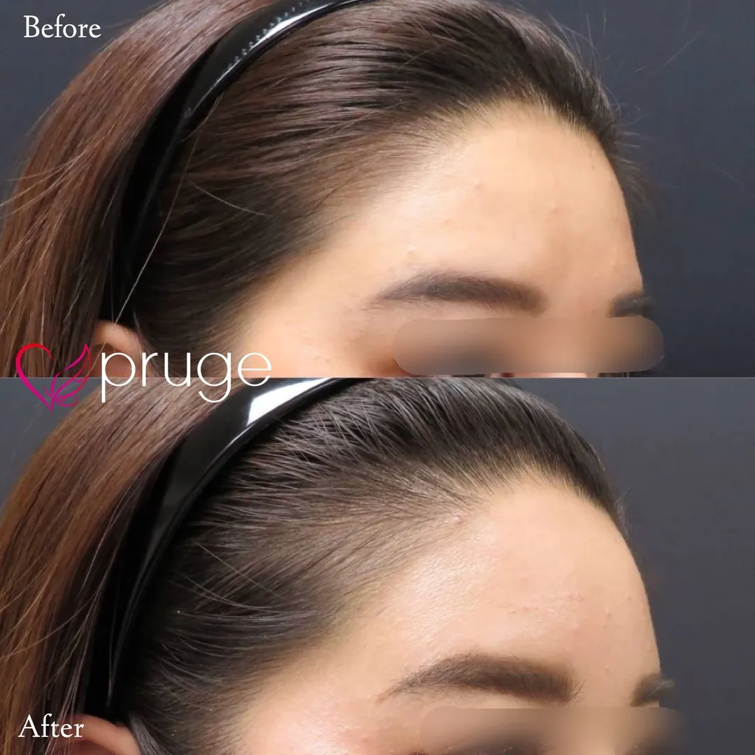 額の傾斜・凹み