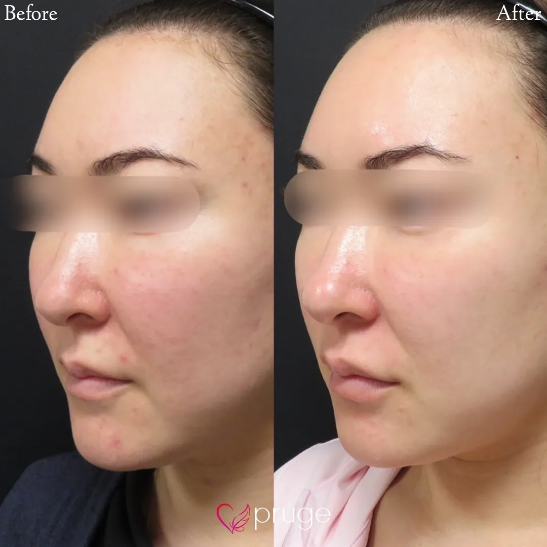 ヴァンパイアフェイシャル（全顔）