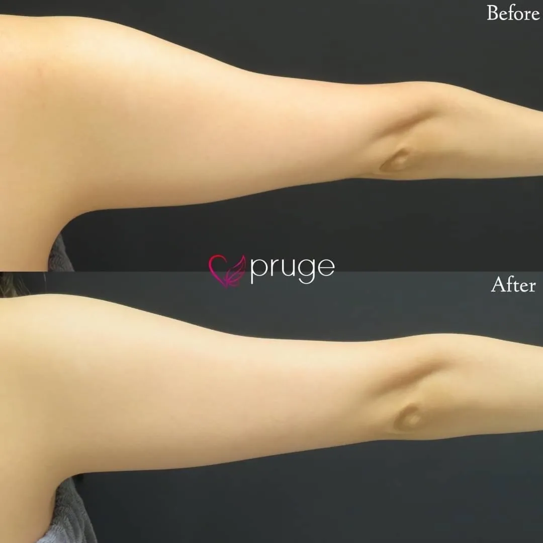 pスリム注射（二の腕）