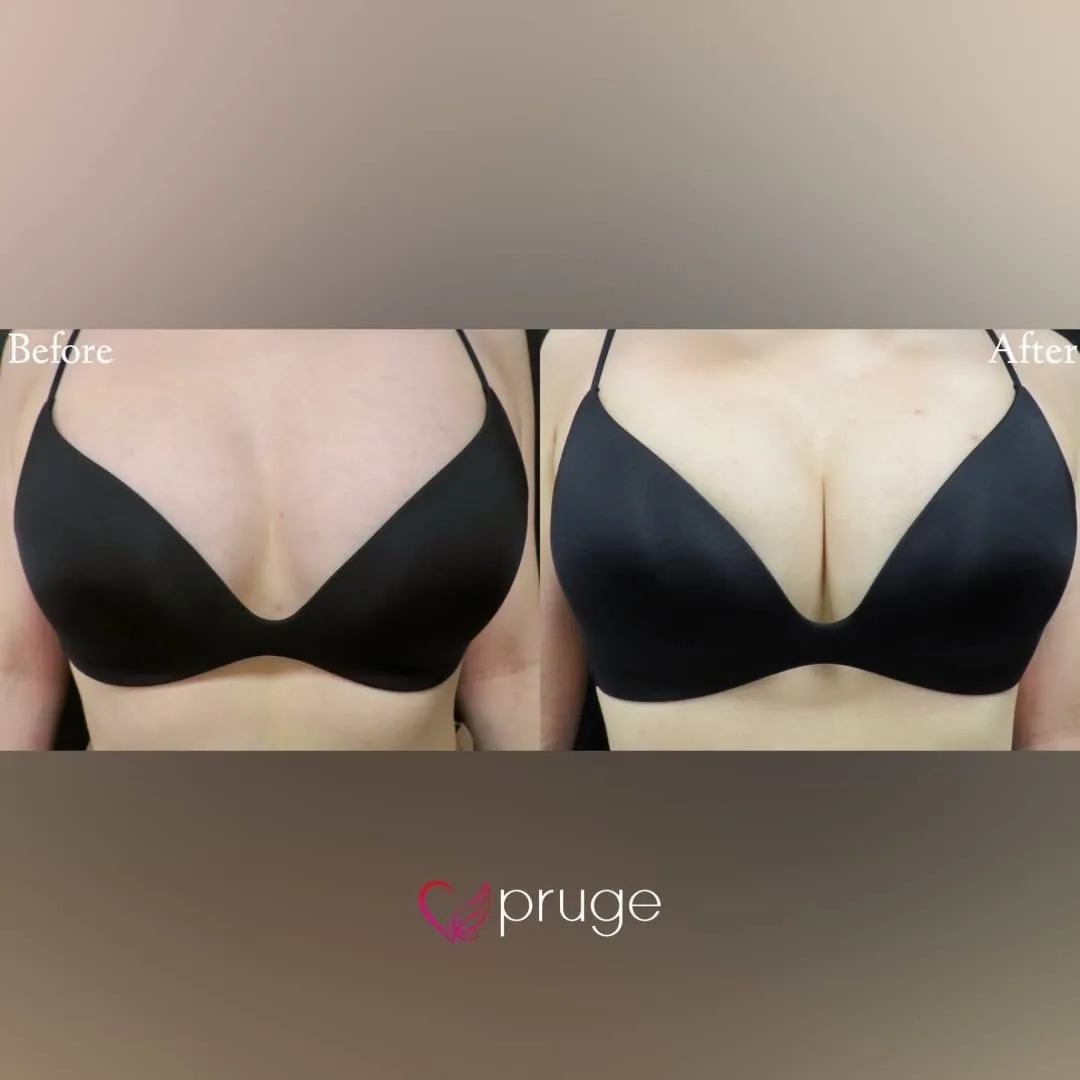 PRP注射（お胸）