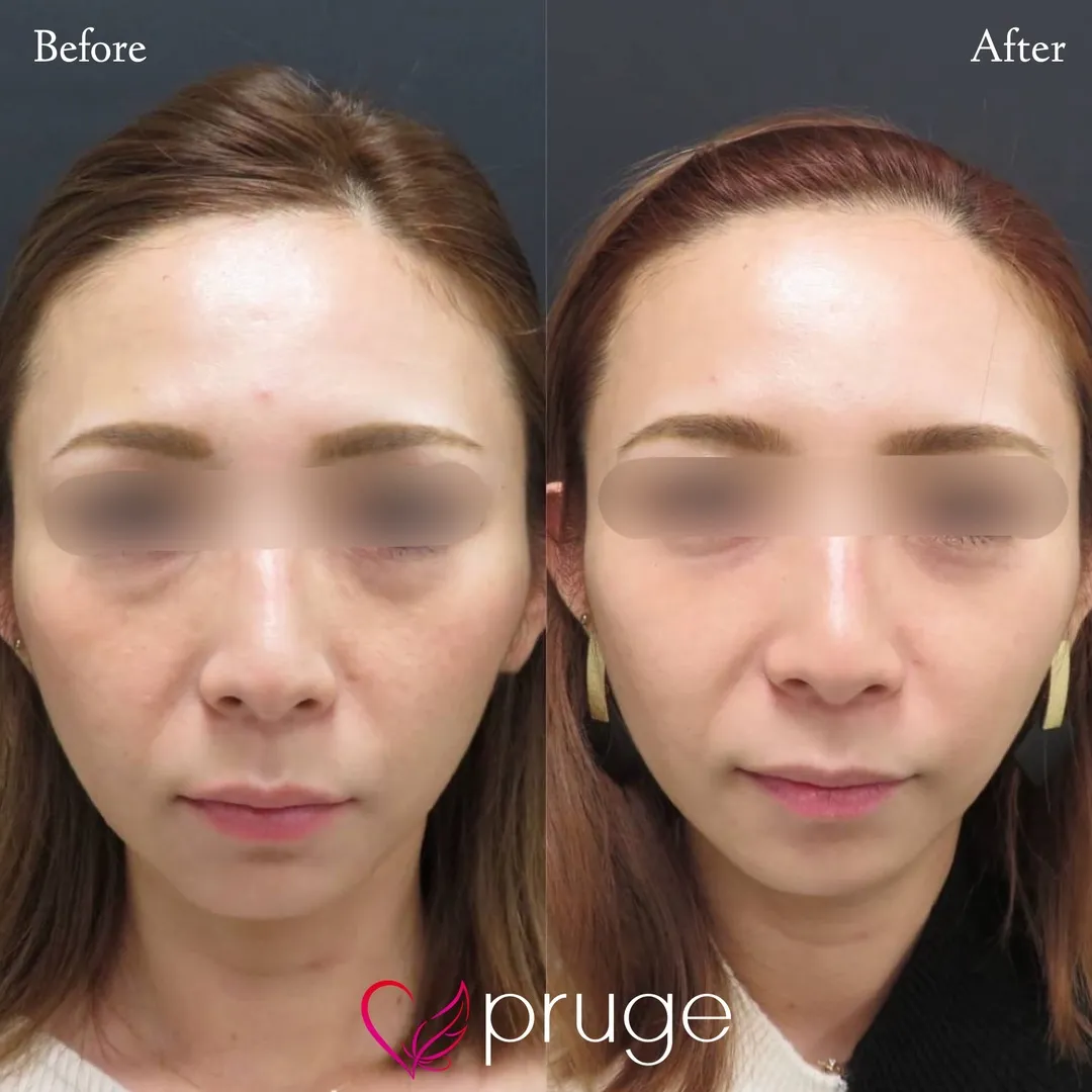 目の下のクマ・ゴルゴライン