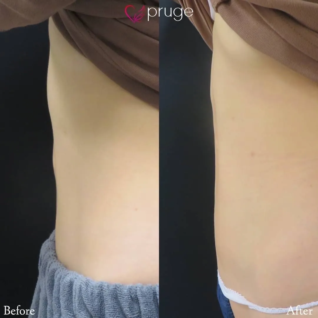 脂肪吸引後修正MAX（お腹）