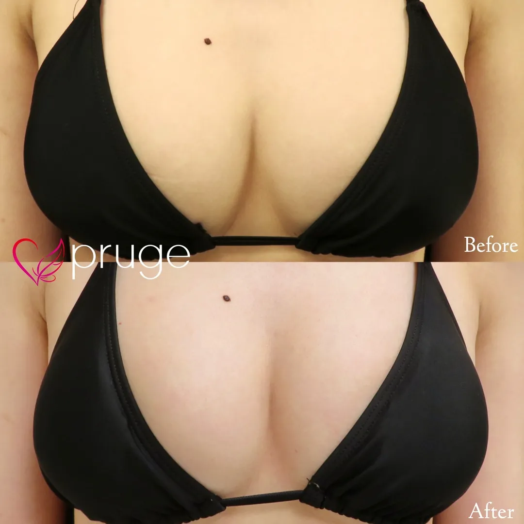 PRP注射（お胸）