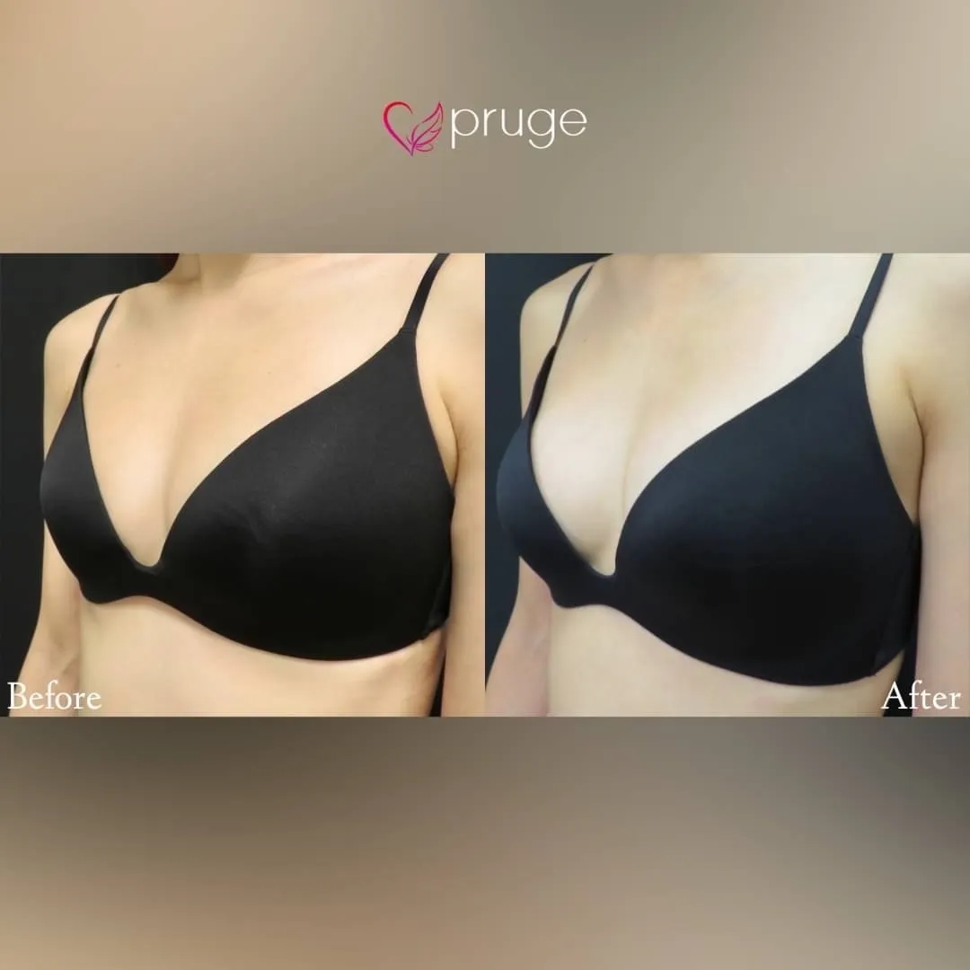 PRP注射（お胸）