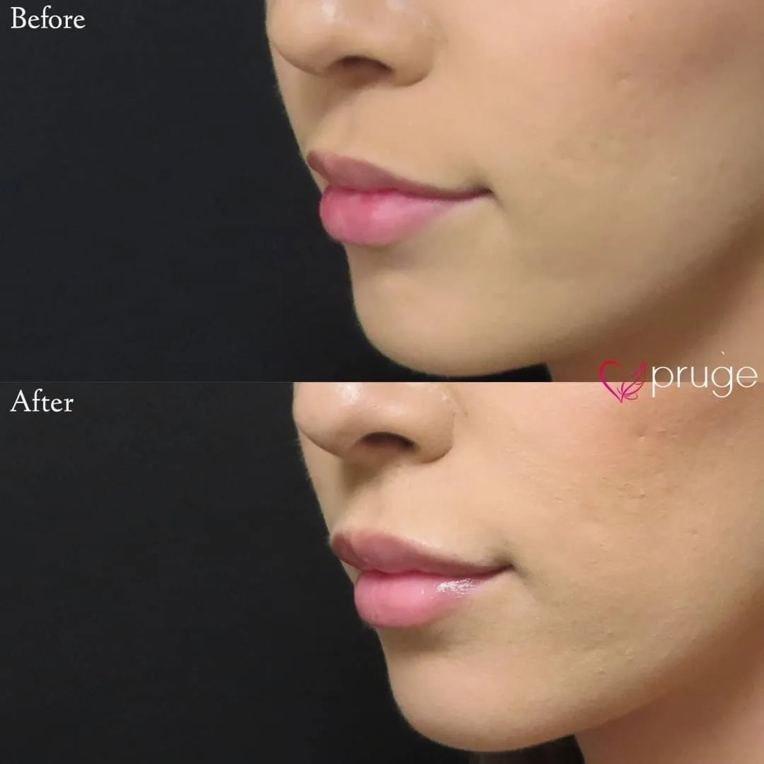 PRP注射（くちびる）