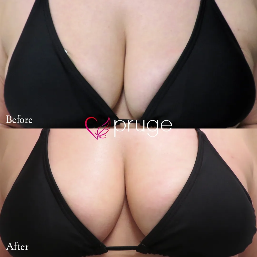 PRP注射（お胸）