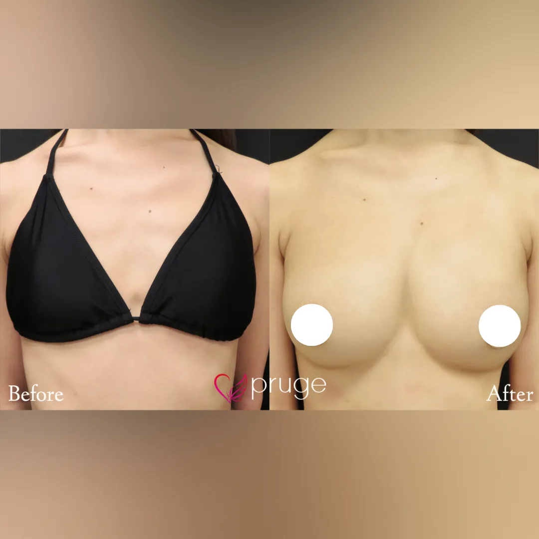 PRP注射（お胸）