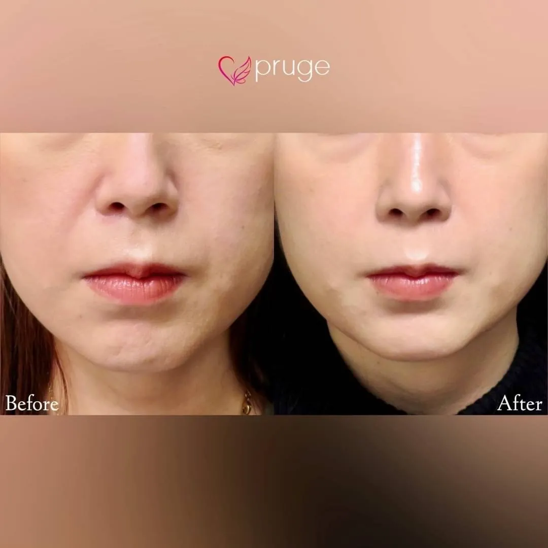 PRP注射（ほうれい線）