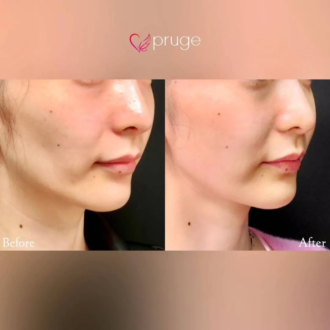 PRP注射（ホホ）