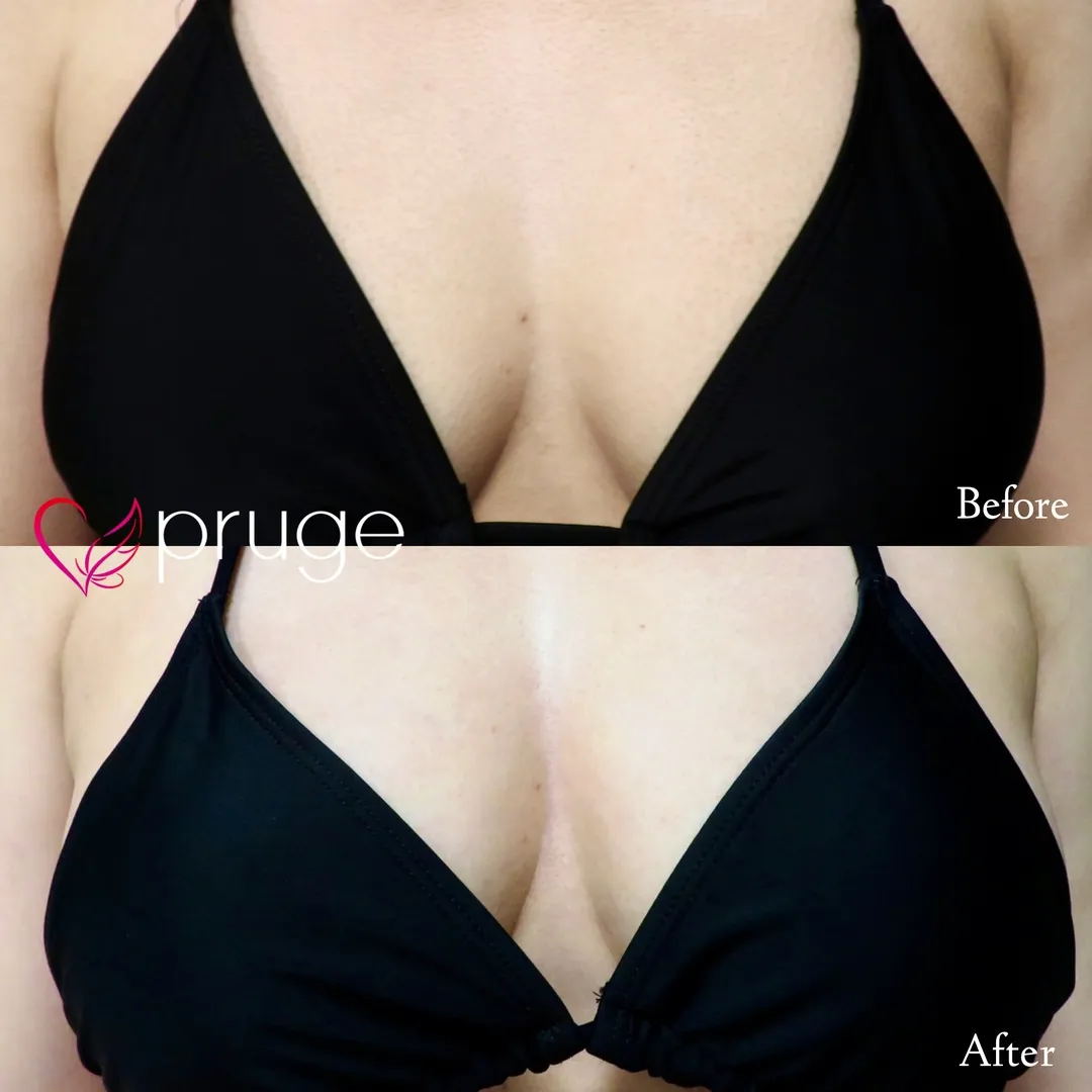 PRP注射（お胸）