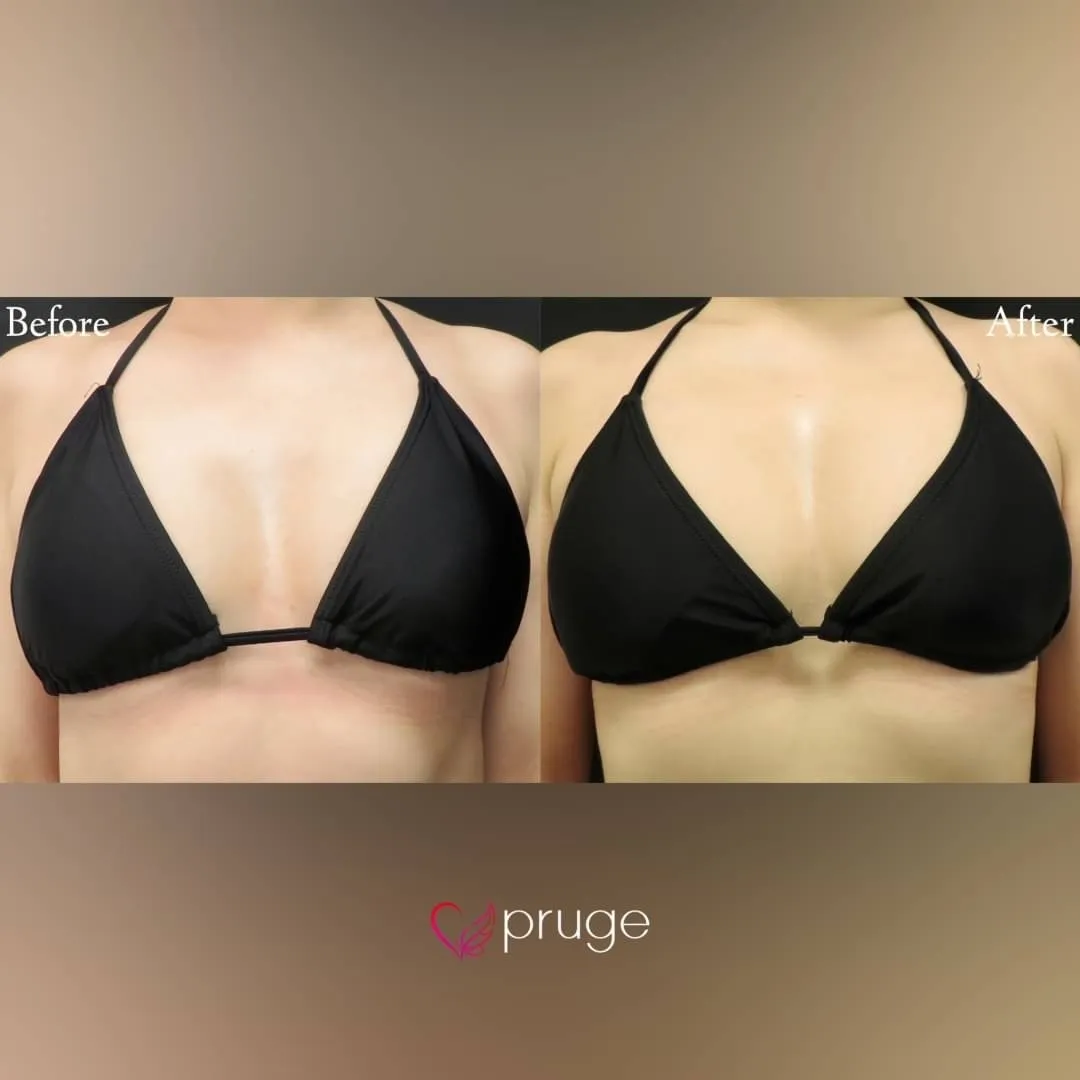 PRP注射（お胸）