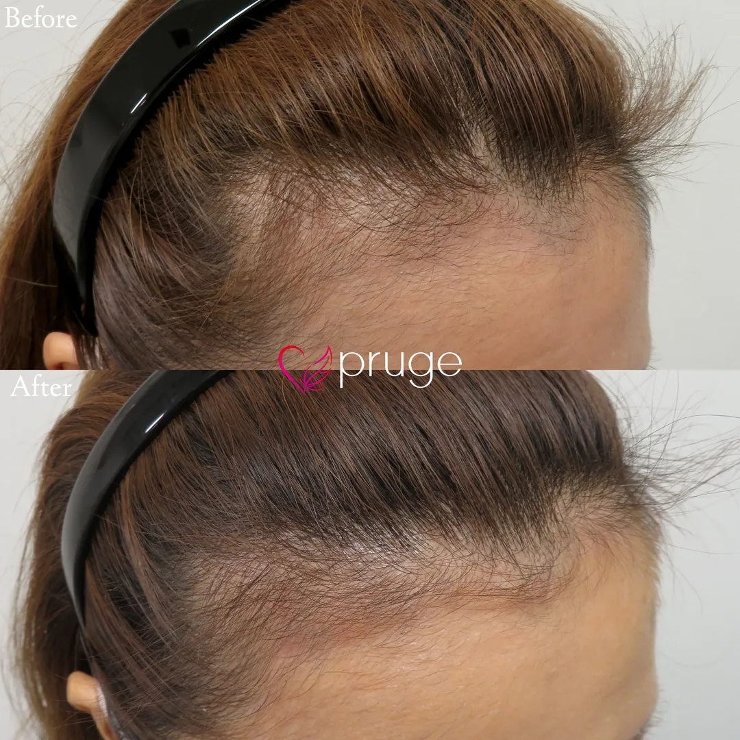 ｐ-スカルプ（2回）