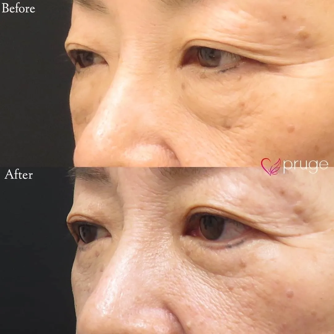 PRP-MI脱脂術(目の下)