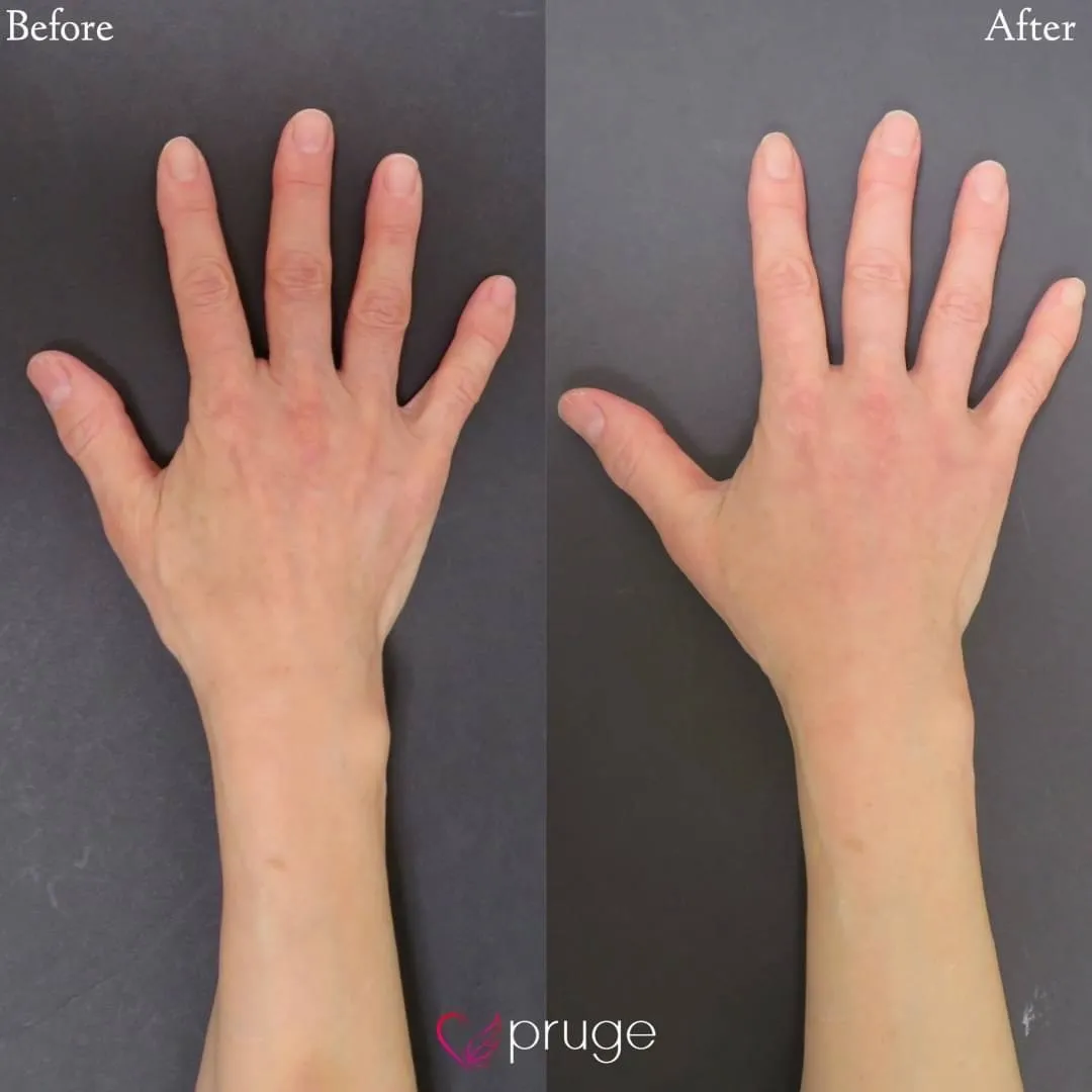 PRP注射（手の甲）