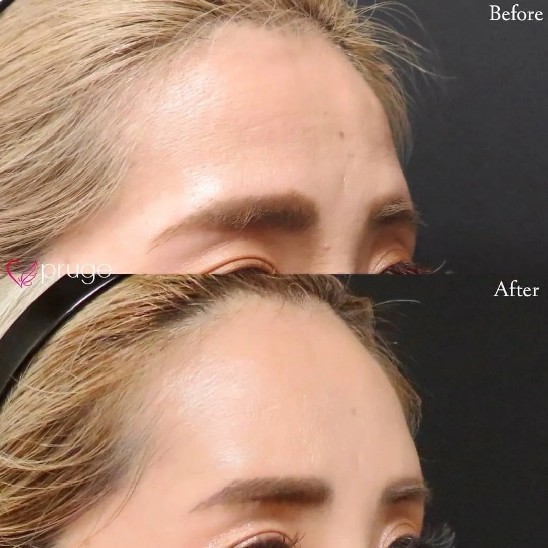 PRP注射(ひたい・こめかみ丸み形成)