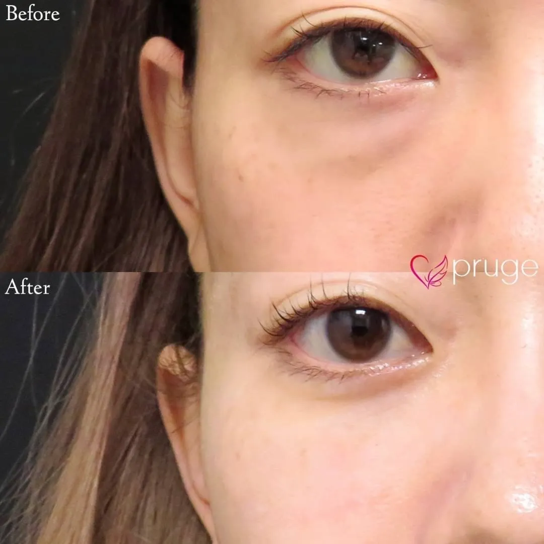 PRP-MI脱脂術(目の下)