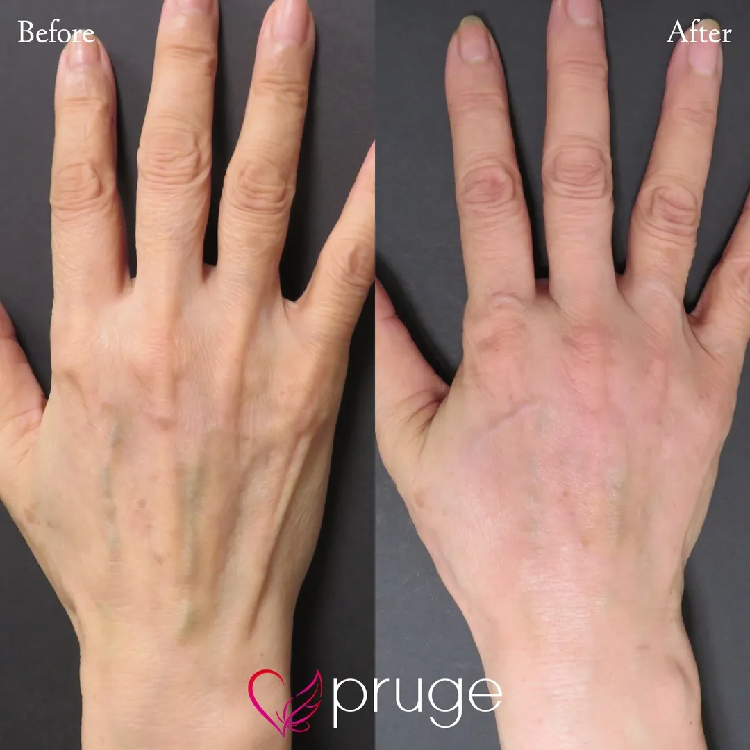 手の甲のスジ・血管