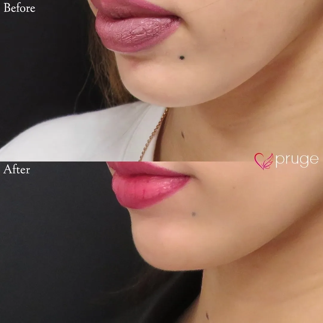 PRP注射（アゴ）