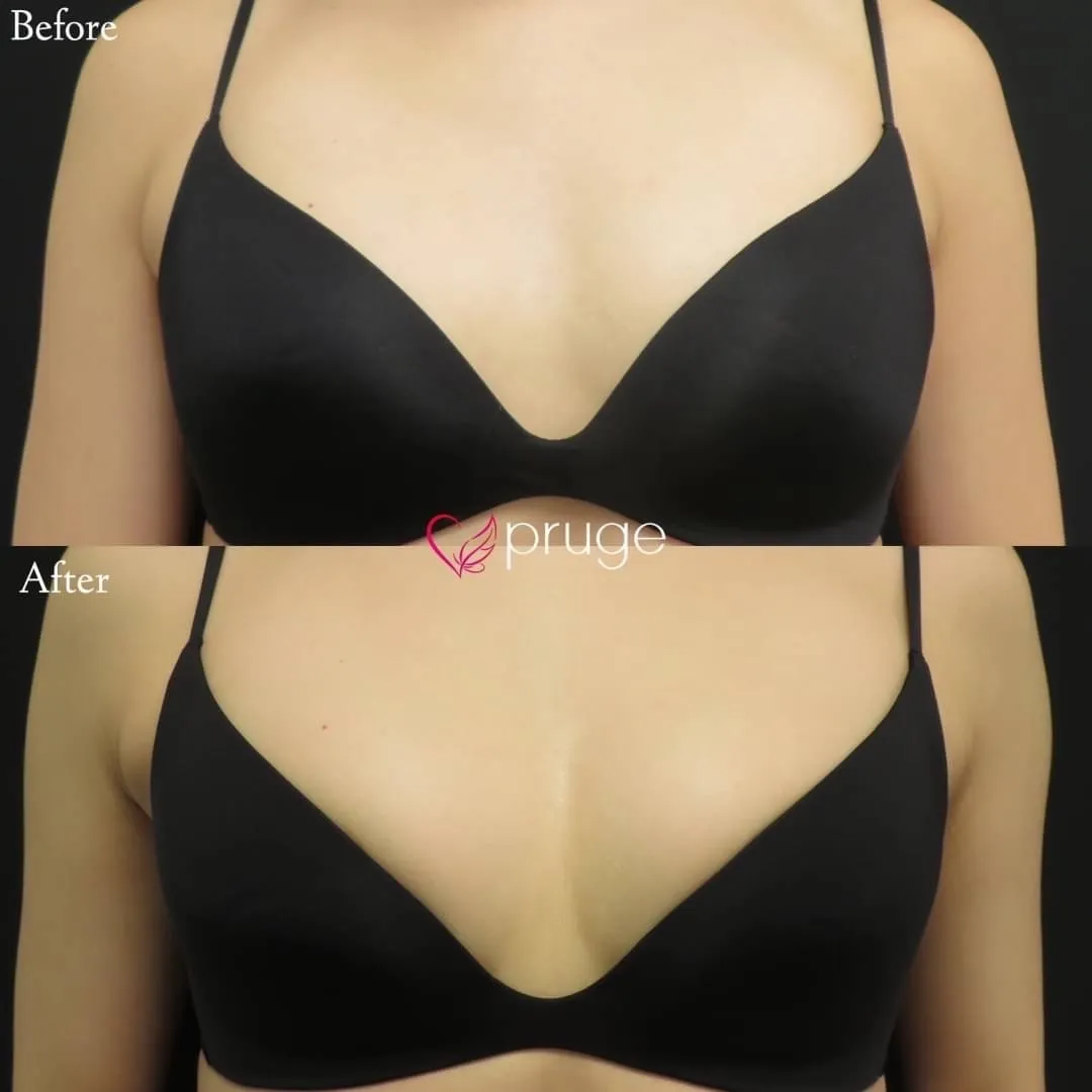 PRP注射（お胸）