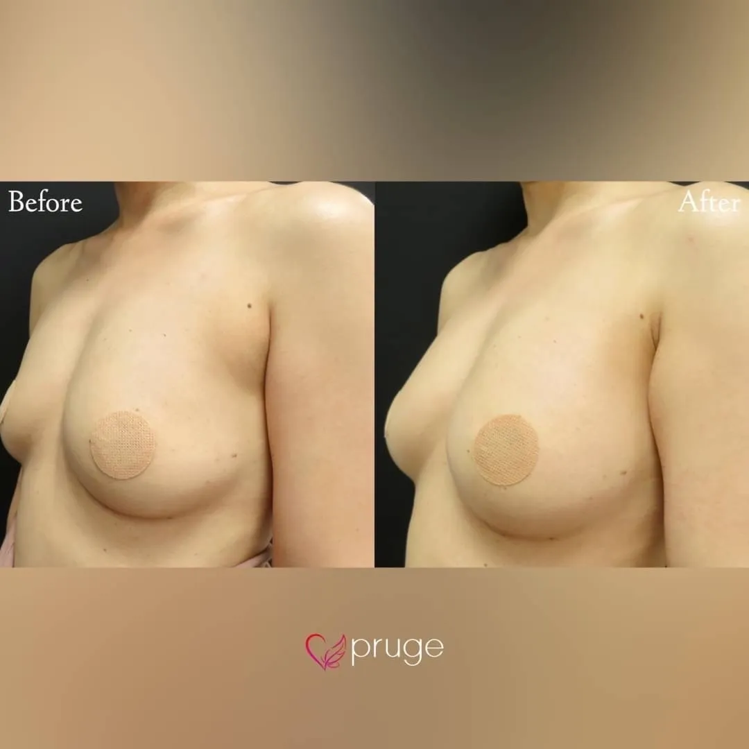 PRP注射によるバストアップ
