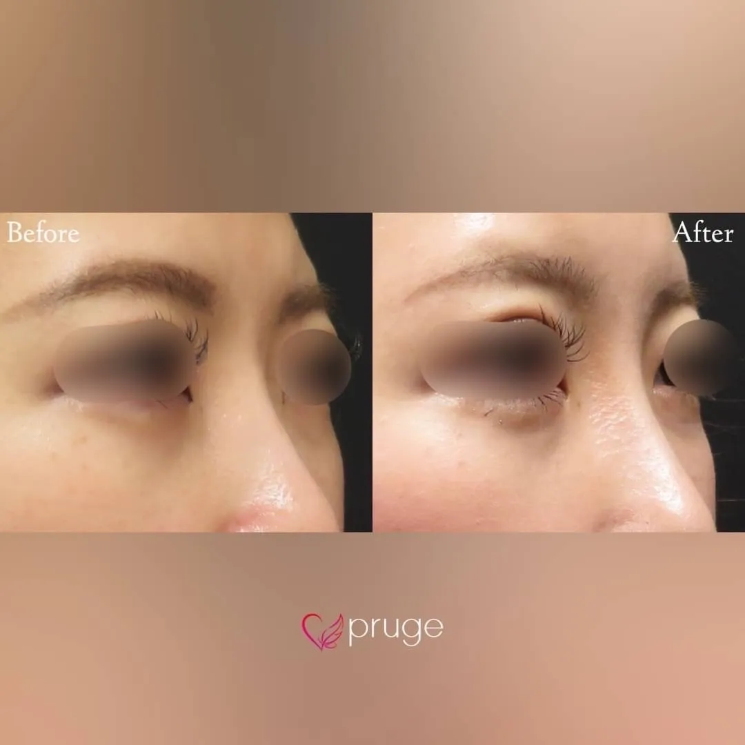 PRP注射（鼻根）