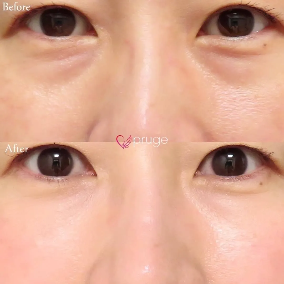 PRP注射アイスプレミアム（目の下）
