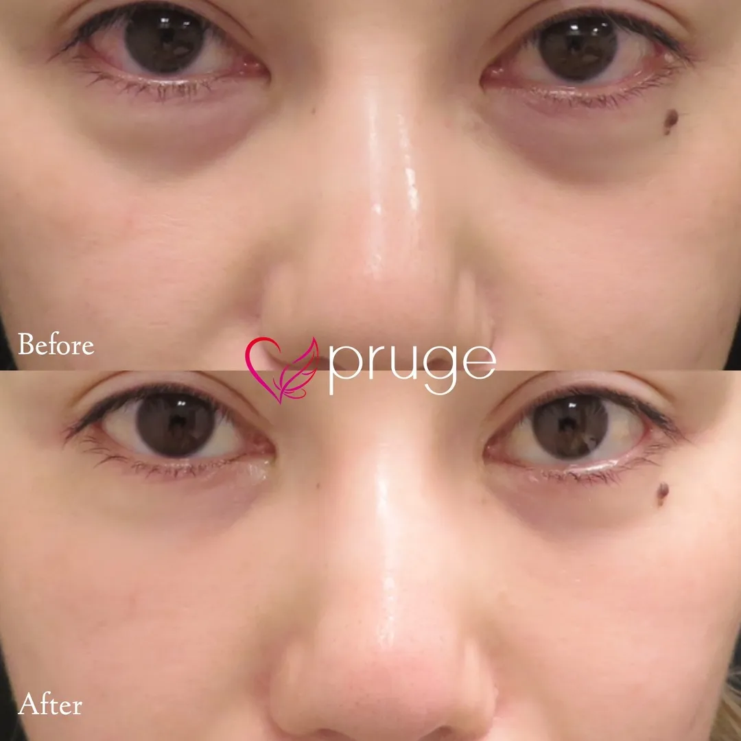 目の下のクマ・たるみ・ゴルゴ