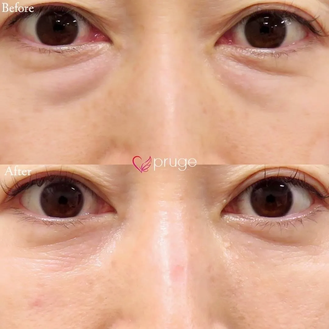 PRP-MI脱脂術（目の下）