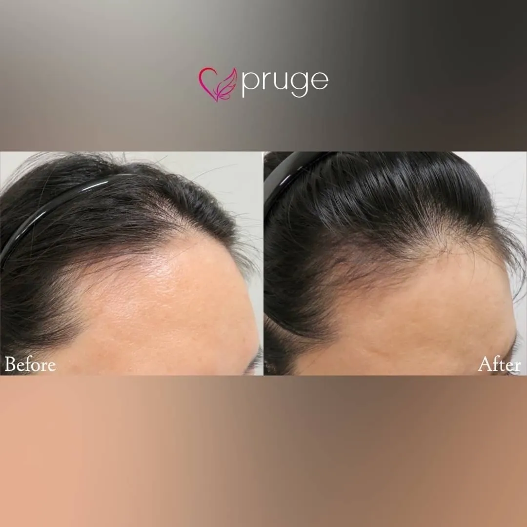 ｐ-スカルプ（1回）